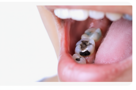 Cavity Prevention: Your Complete Guide