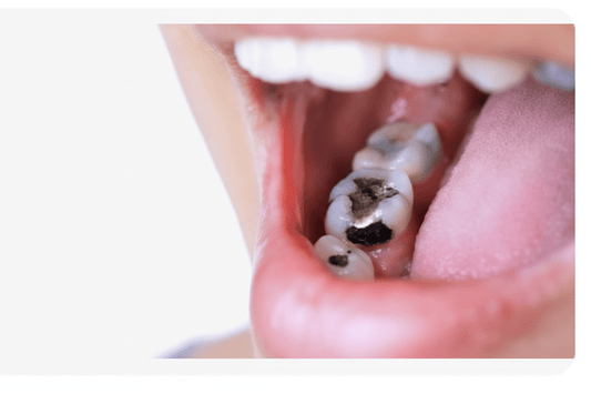 Cavity Prevention: Your Complete Guide - Direct2Customer